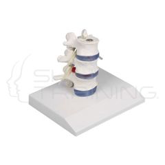 Lumbar Vertebrae with Prolapsed Discs w. stan