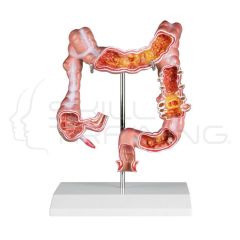 Colon Model with Diseases