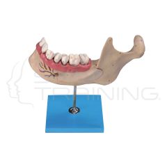 Lower Jaw of 18 Year-old
