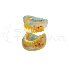 Transparent Dental Pathology Model 16 signs
