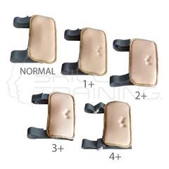 Pitting Edema model