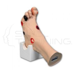 WILMA Wound Foot