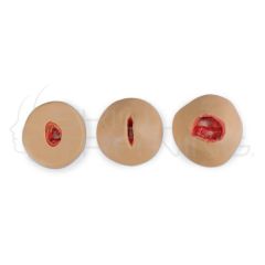 Negative-Pressure Wound Therapy (NPWT)