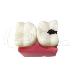 Caries Tooth Models (Nissin Compartible - A27A-46F)