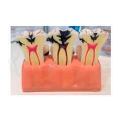 Modelo desmontado de caries de 4 veces el Tamano Normal