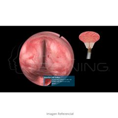 VirtaMed UroS™ TURP Module