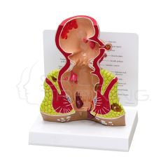 Modelo Anatomico de Recto con Patologias
