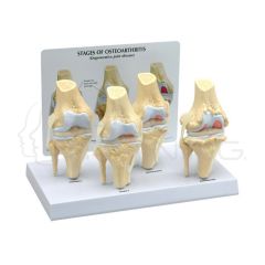 Artrosis de Rodilla de 4 Etapas