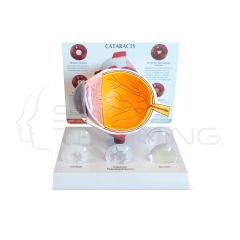 Modelo de Ojo con Catarata