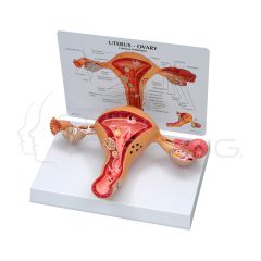 Utero con Patologia Benigna y Maligna