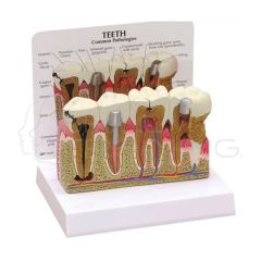 Modelo anatomico de dientes y encias enfermas