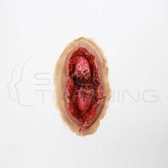 Fractura Expuesta - Moulage