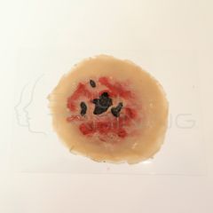 Moulage de Quemadura Térmica